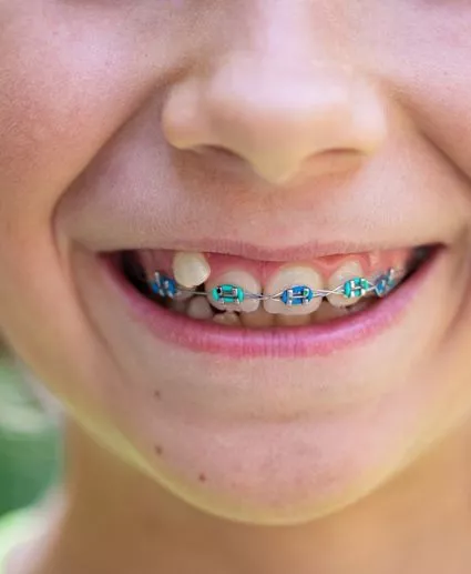 color braces