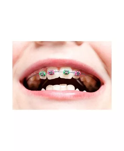 color braces